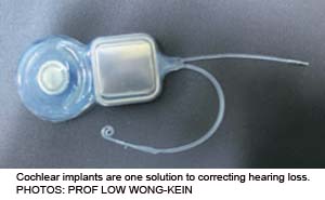 cochlear implant